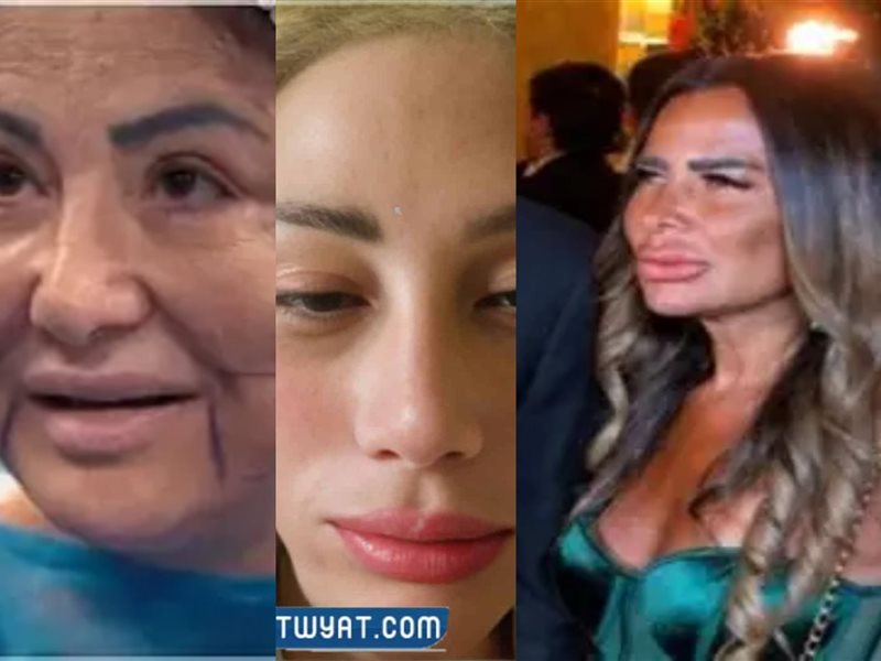 نجمات تشوهن بسبب عمليات التجميل